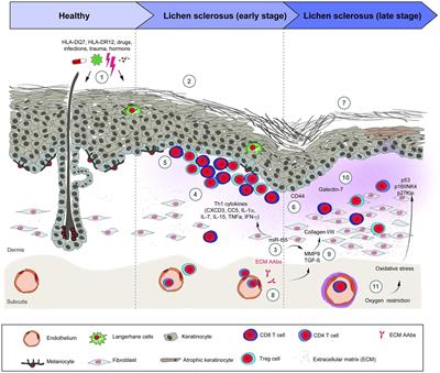 Lichen sclerosus: The 2023 update